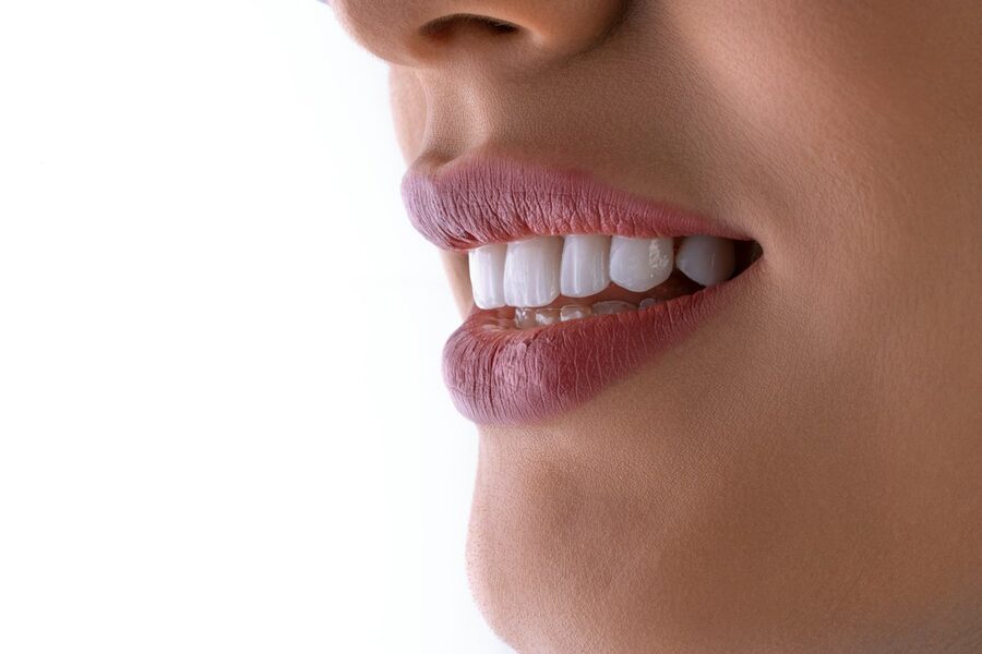 Albirea dentară profesională vs. albirea acasă