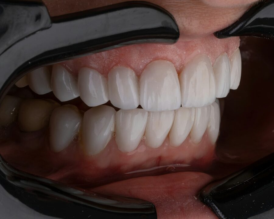 Restaurări Dentare